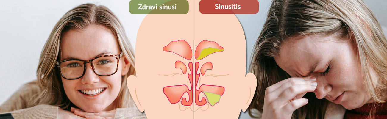 Sinusitis